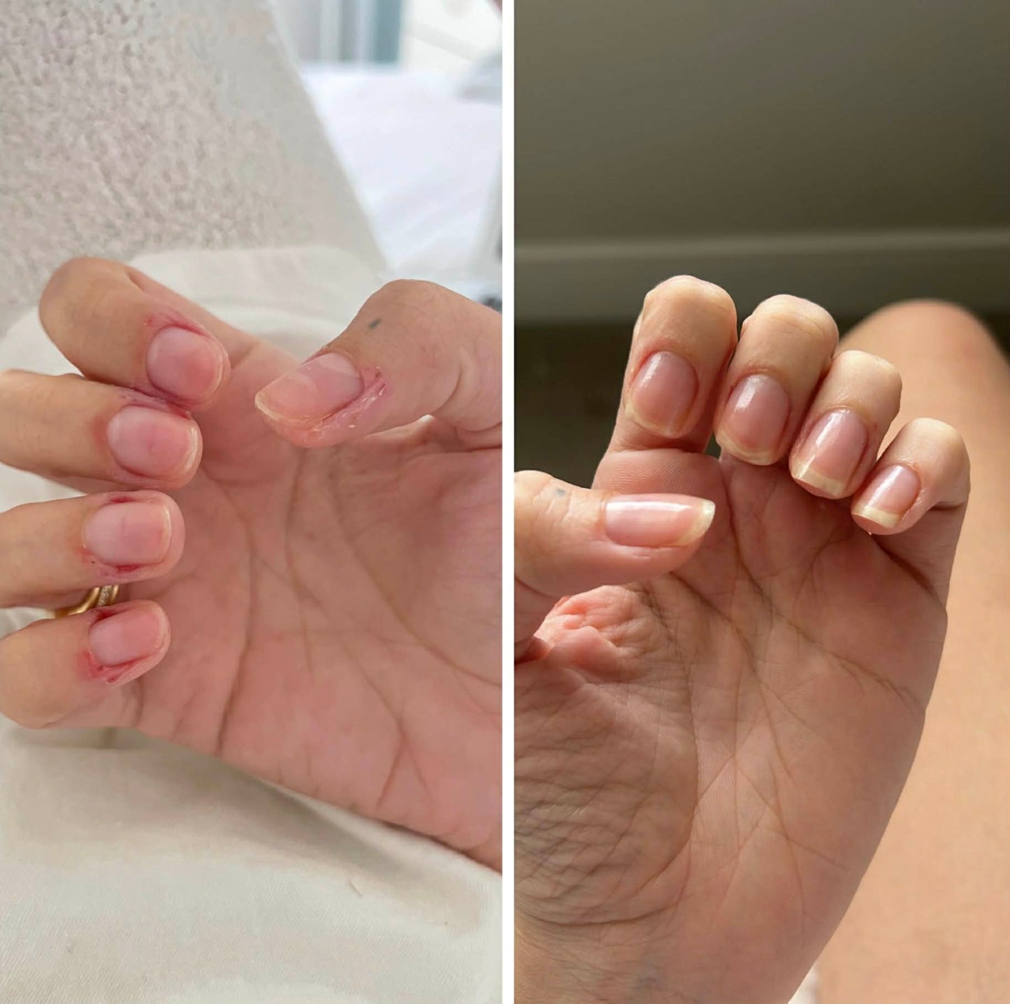 Stronger, longer and Healthier Nails After Consistent Use of nail growth oil