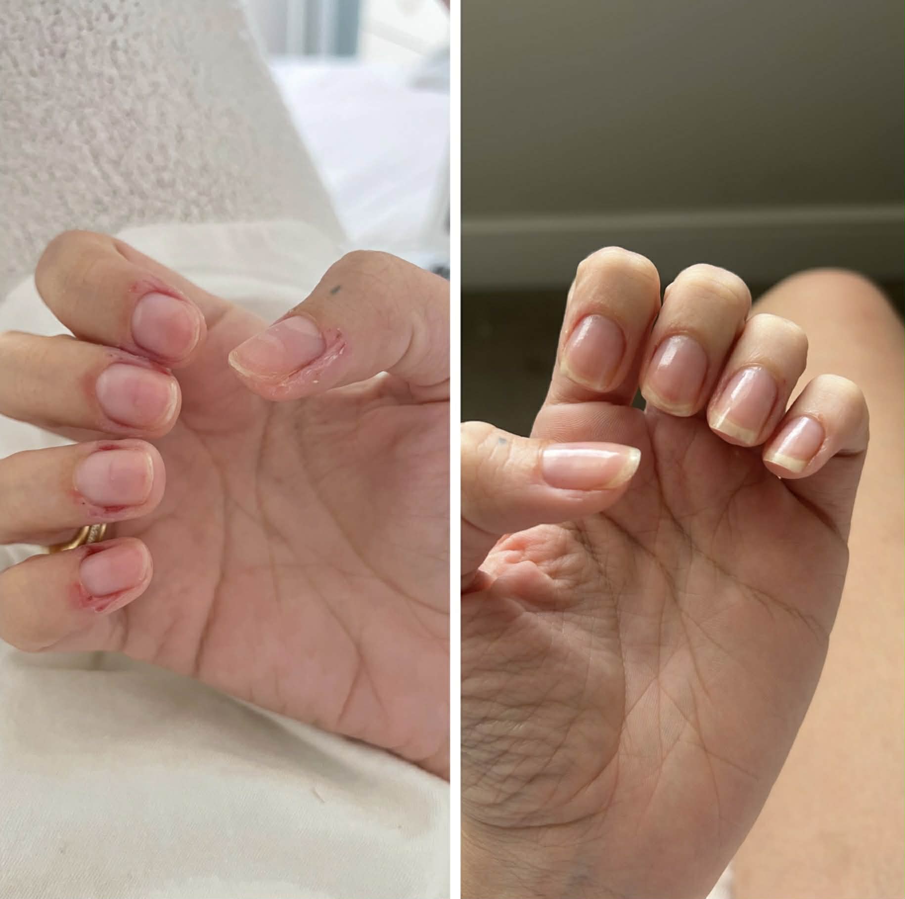Stronger, longer and Healthier Nails After Consistent Use of nail growth oil